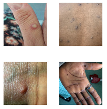 NHS-MonkeyPox-collage.jpg